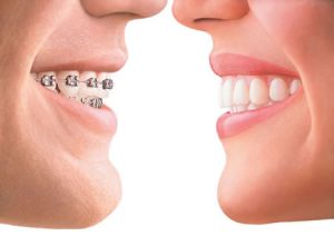 Invisalign-Zaragoza-Brackets-Moliner y Aragón-Ortodoncia-Invisible