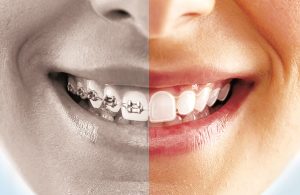 Fotomontaje-Invisalign-Alineador-Brackets-Ortodoncia-Zaragoza-Moliner y Aragón